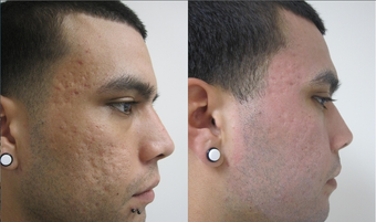 Fractional CO2 Resurfacing for Acne