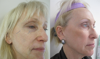 Fractional CO2 Laser Resurfacing