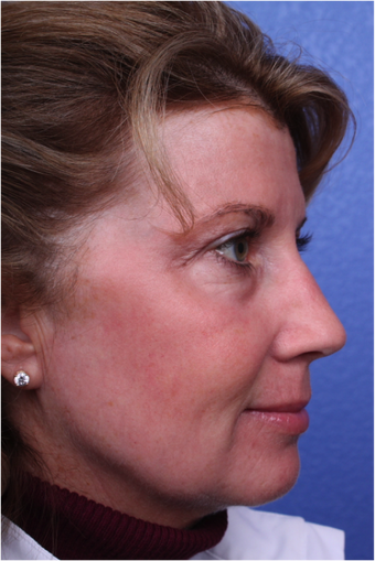 Laser Resurfacing