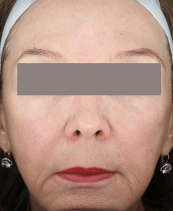 Fractional Resurfacing