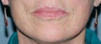 Fractional CO2 Laser Treatment