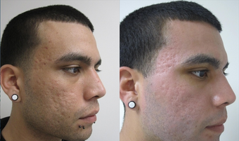 Fractional CO2 Resurfacing for Acne
