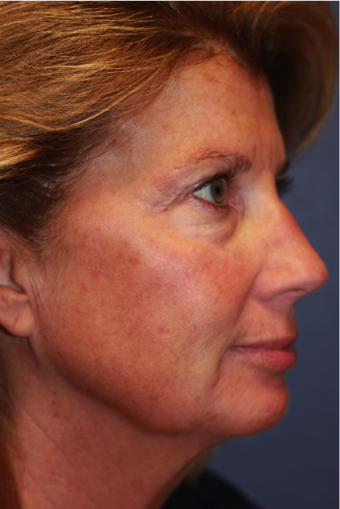 Laser Resurfacing