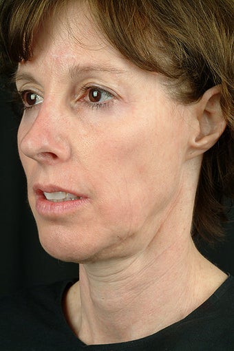 Fractional CO2 Laser