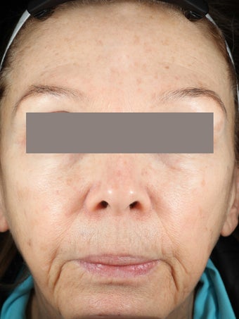 Fractional Resurfacing