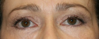 Fraxel Laser 