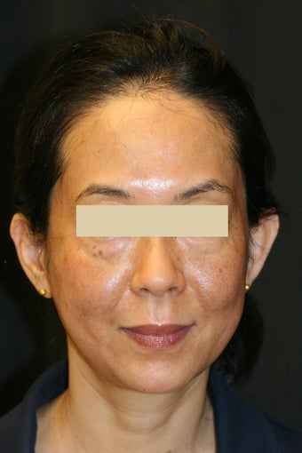 Fraxel Laser