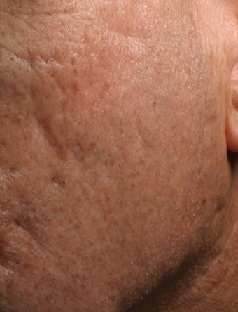 Fraxel - acne scars