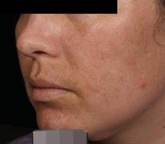 Fraxel - Melasma