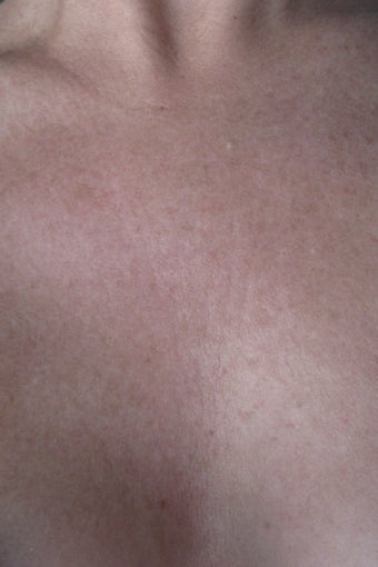 Chest wrinkles treated with Fraxel Restore