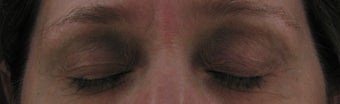 Fraxel for eyelid lift