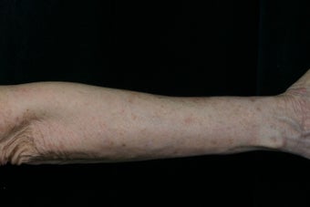 Dual Fraxel Laser 