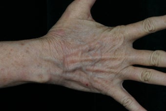 Dual Fraxel  Laser 