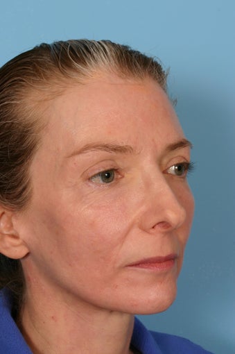 Fraxel Laser treatment