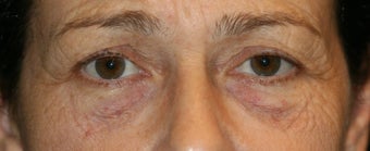 Fraxel Laser 