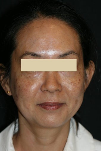 Fraxel Laser