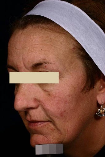 Fraxel