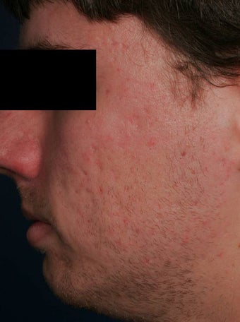 Fraxel - acne scars