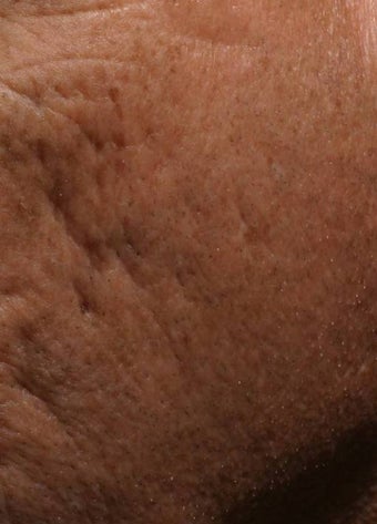 Fraxel - acne scars