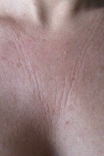 Chest wrinkles treated with Fraxel Restore