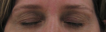 Fraxel for eyelid lift