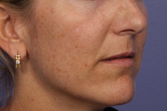 Fraxel Dual Laser 