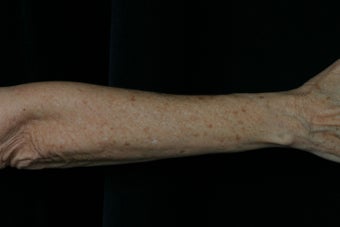 Dual Fraxel Laser 