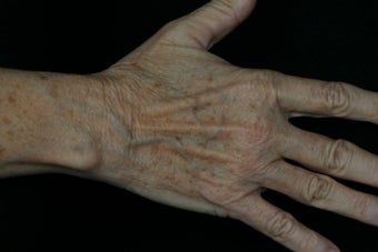 Dual Fraxel  Laser 