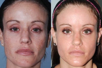 Fraxel Restore Dual Laser Treatments
