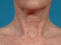 Laser resurfacing-Fraxel Re:store