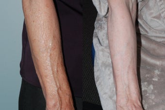 Fraxel Restore Dual Laser Treatment