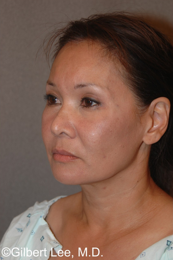 Fraxel Laser Rejuvenation