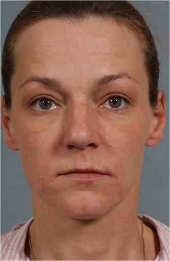 41 Year Old Female Treated for sun damage, wrinkles, and acne scars