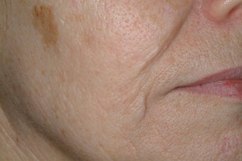 Acne scars treated with Fraxel