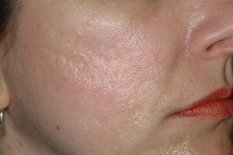 Fraxel Laser