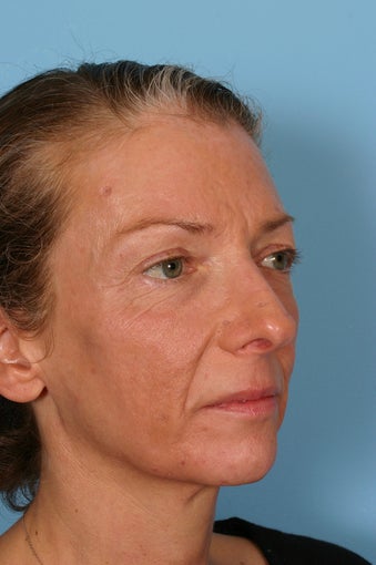 Fraxel Laser treatment
