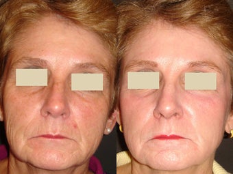 Fraxel Laser Treatment