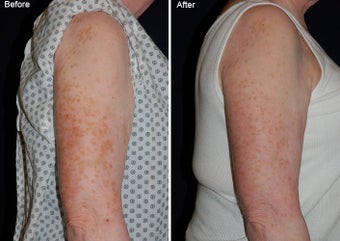 Fraxel laser resurfacing 