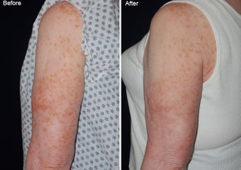 Fraxel laser resurfacing 