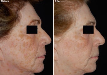 Fraxel Laser Resurfacing