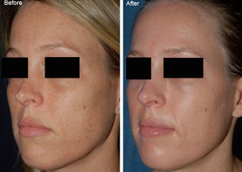 Fraxel Laser Resurfacing