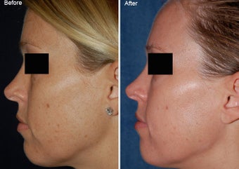 Fraxel Laser Resurfacing