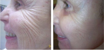 Fraxel Repair