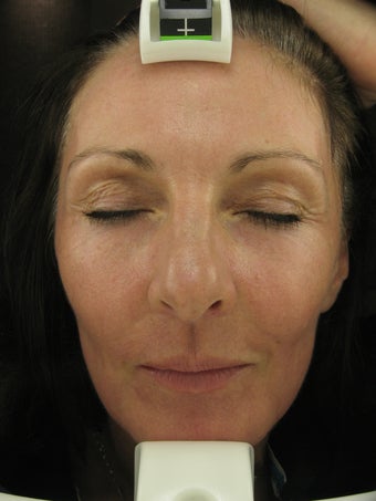 Fraxel re:pair CO2 laser resurfacing treatment
