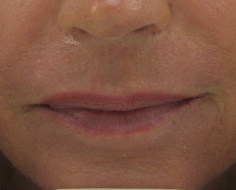 Fraxel re:pair (repair) CO2 laser resurfacing for scar improvement