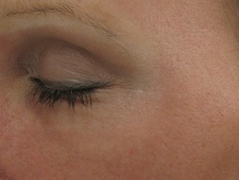 Fraxel re:pair (repair) Fractional CO2 Laser resurfacing Blepharoplasty