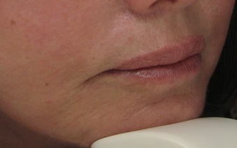 Fraxel Re:pair (repair) CO2 Laser Resurfacing Treatment around the mouth