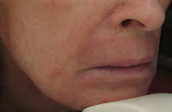 Fraxel repair for Lip, Marionette, and Nasolabial Lines