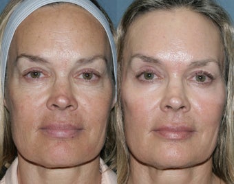Fraxel Repair for sun damage and wrinkles
