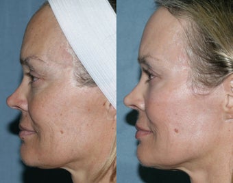 Fraxel Repair for sun damage and wrinkles